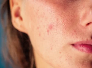 woman problem skin acne pimples